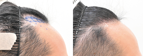 自毛植毛の症例写真ビフォーアフター4
