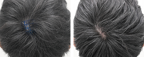 自毛植毛の症例写真ビフォーアフター4