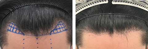 自毛植毛の症例写真ビフォーアフター4