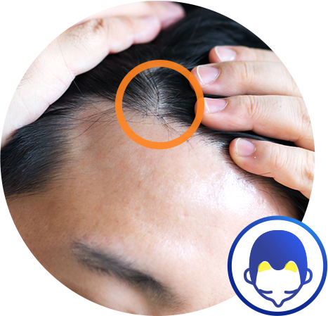 ちょこっと植毛