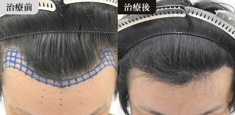 40代男性 症例写真 6ヶ月後