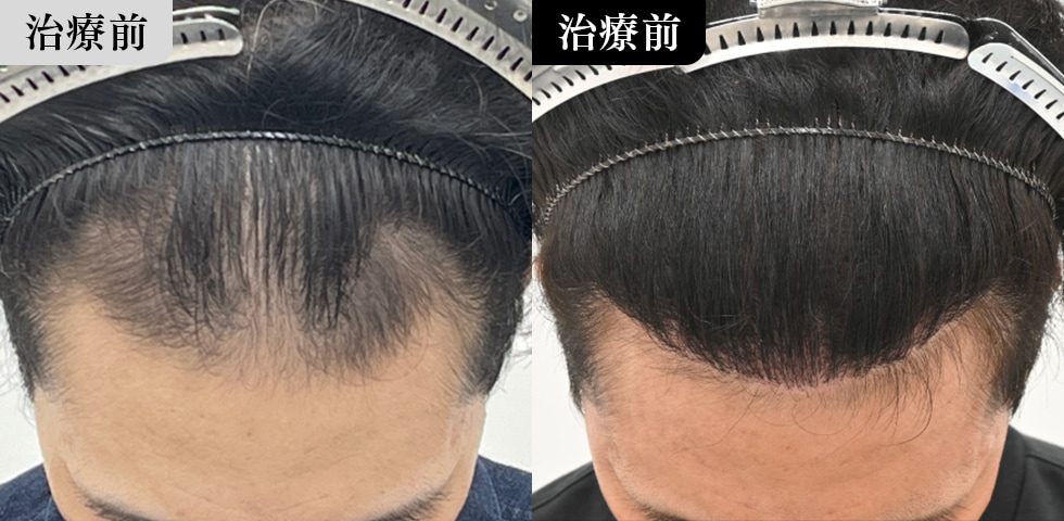 40代男性 症例写真 6ヶ月後