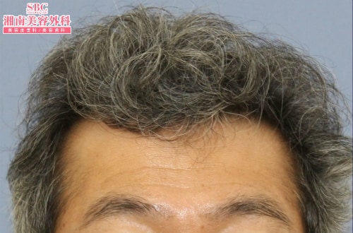 治療開始後12ヶ月