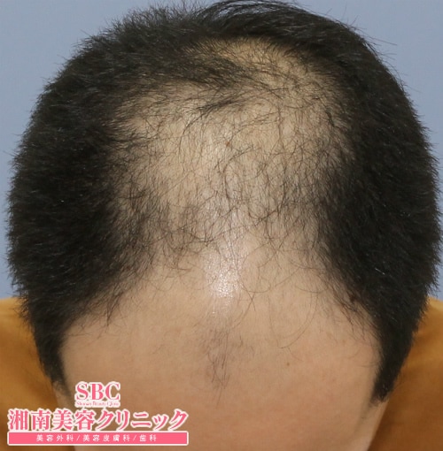 術前
