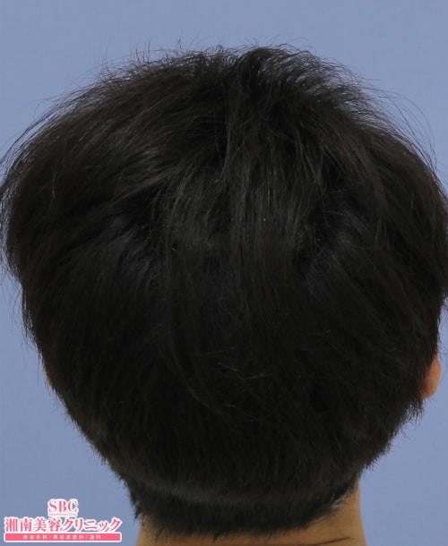 治療開始後12ヶ月