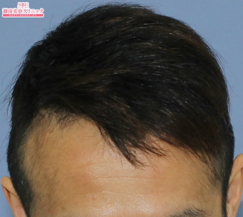 治療開始後6ヶ月