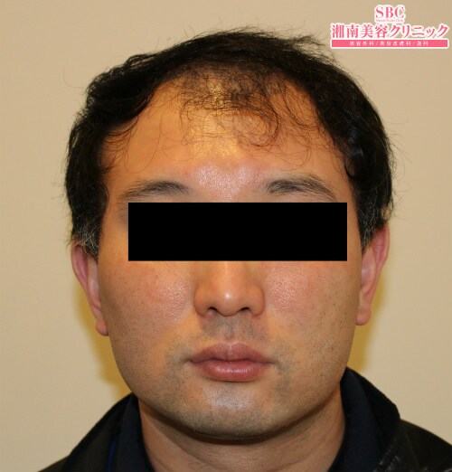 術前