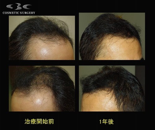 治療開始後12ヶ月