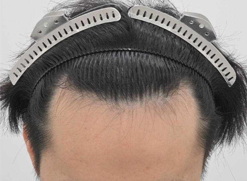 自毛 症例1