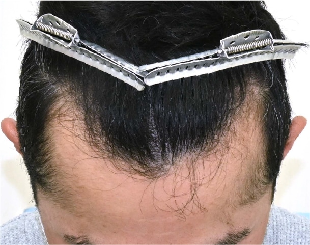 毛根再生注射×臍帯幹細胞上清液メソ 症例1 after