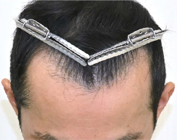 毛根再生注射×臍帯幹細胞上清液メソ 症例1