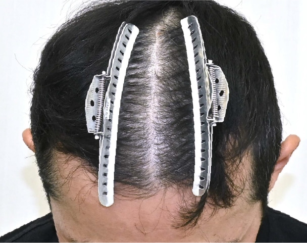 毛根再生注射×臍帯幹細胞上清液メソ 症例2