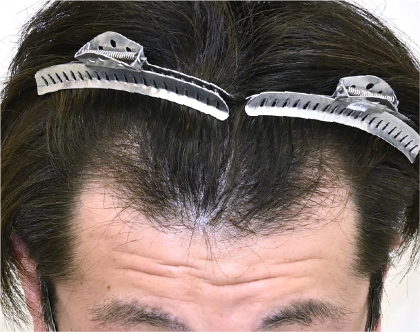 毛根再生注射×臍帯幹細胞上清液メソ 症例3 after