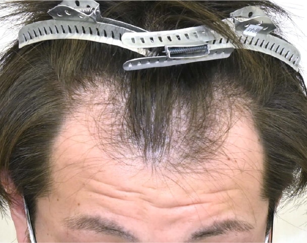 毛根再生注射×臍帯幹細胞上清液メソ 症例3