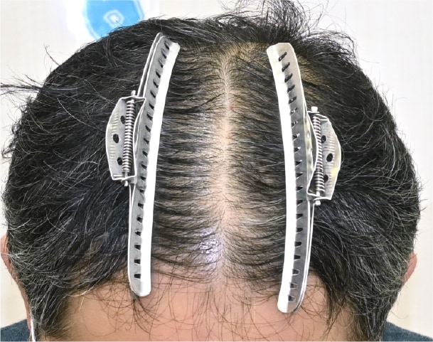 毛根再生注射×臍帯幹細胞上清液メソ 症例4