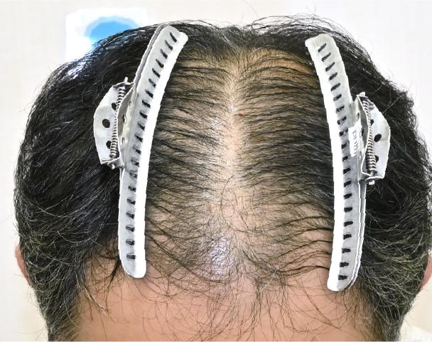 毛根再生注射×臍帯幹細胞上清液メソ 症例4