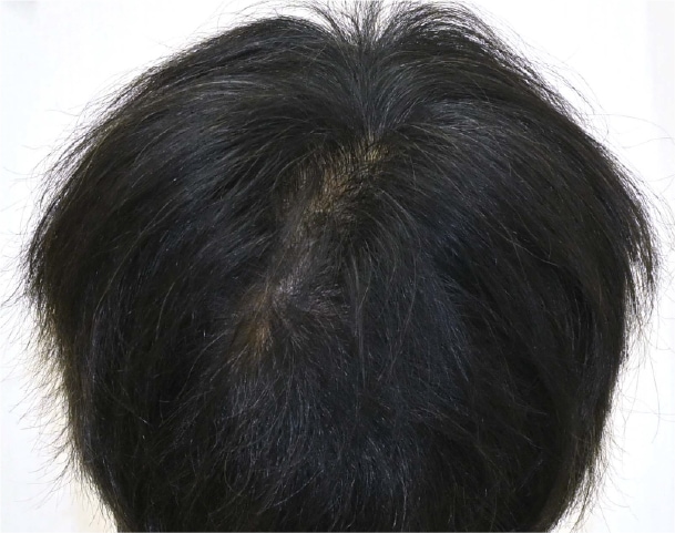 毛根再生注射×臍帯幹細胞上清液メソ 症例5