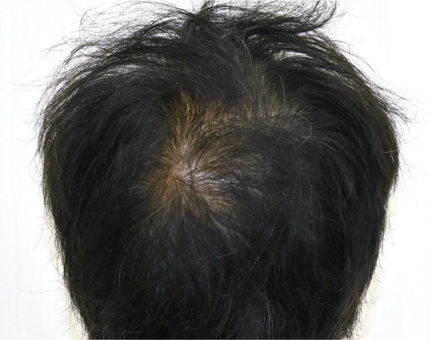 毛根再生注射×臍帯幹細胞上清液メソ 症例5
