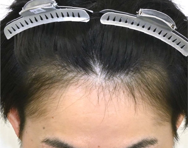 毛根再生注射×臍帯幹細胞上清液メソ 症例6
