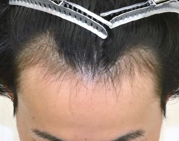 毛根再生注射×臍帯幹細胞上清液メソ 症例6