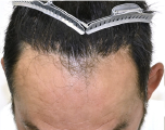 自毛 症例2　after