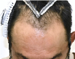 自毛 症例2