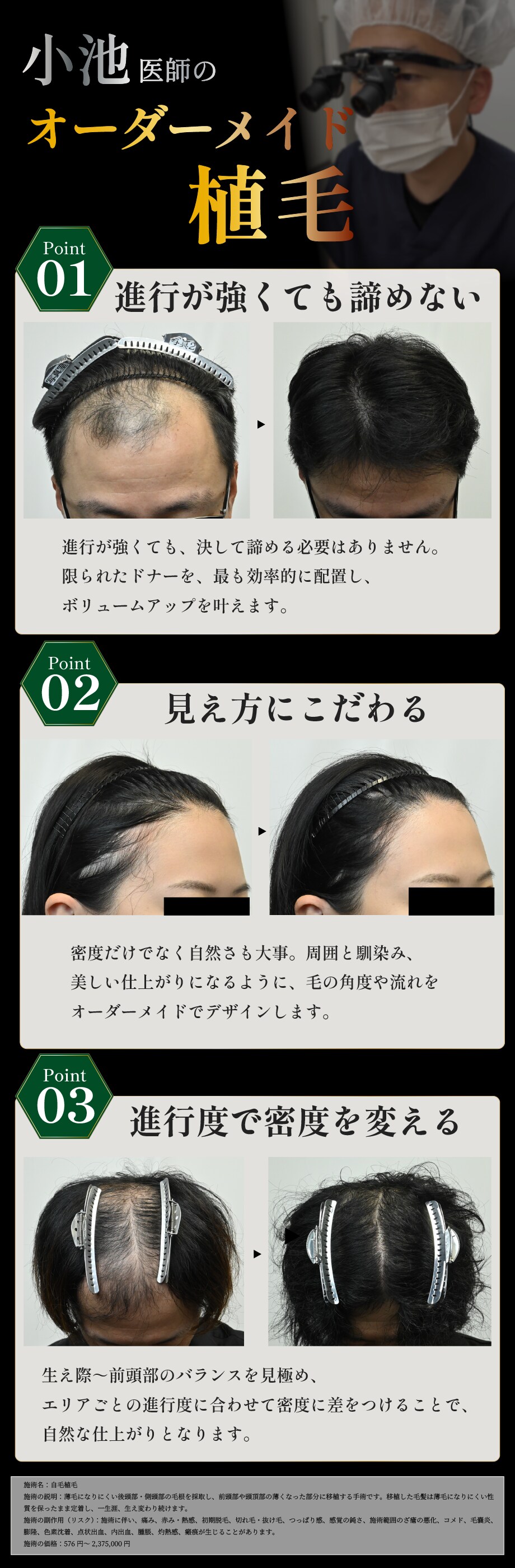 小池医師のオーダーメイド植毛