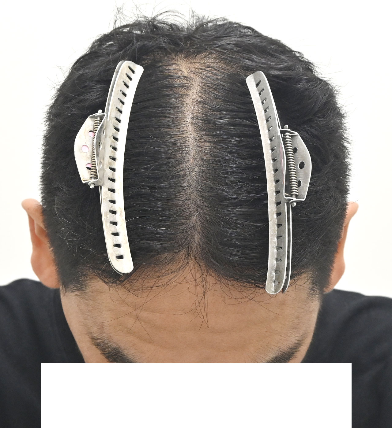 自毛 症例1　after