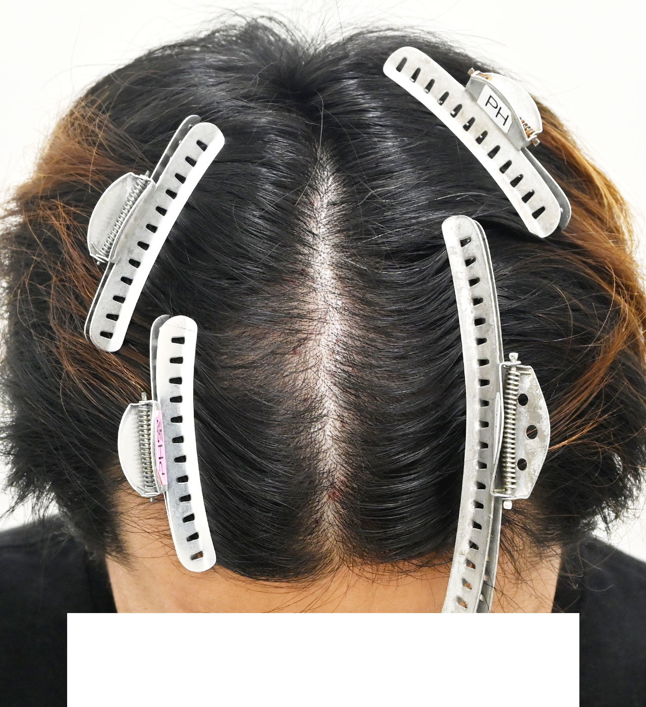 自毛 症例2　after