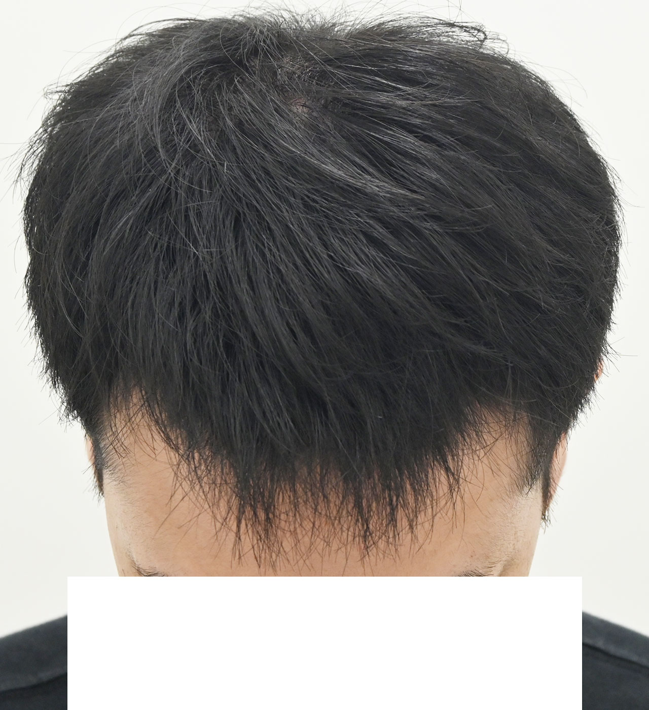 自毛 症例3　after