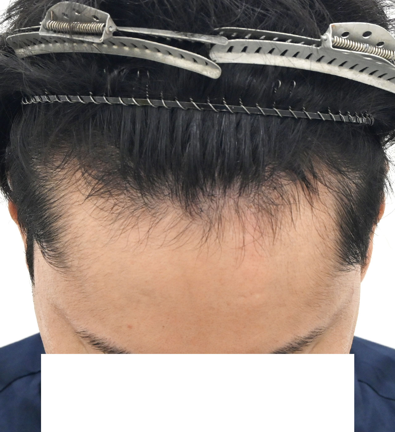 自毛 症例4　after