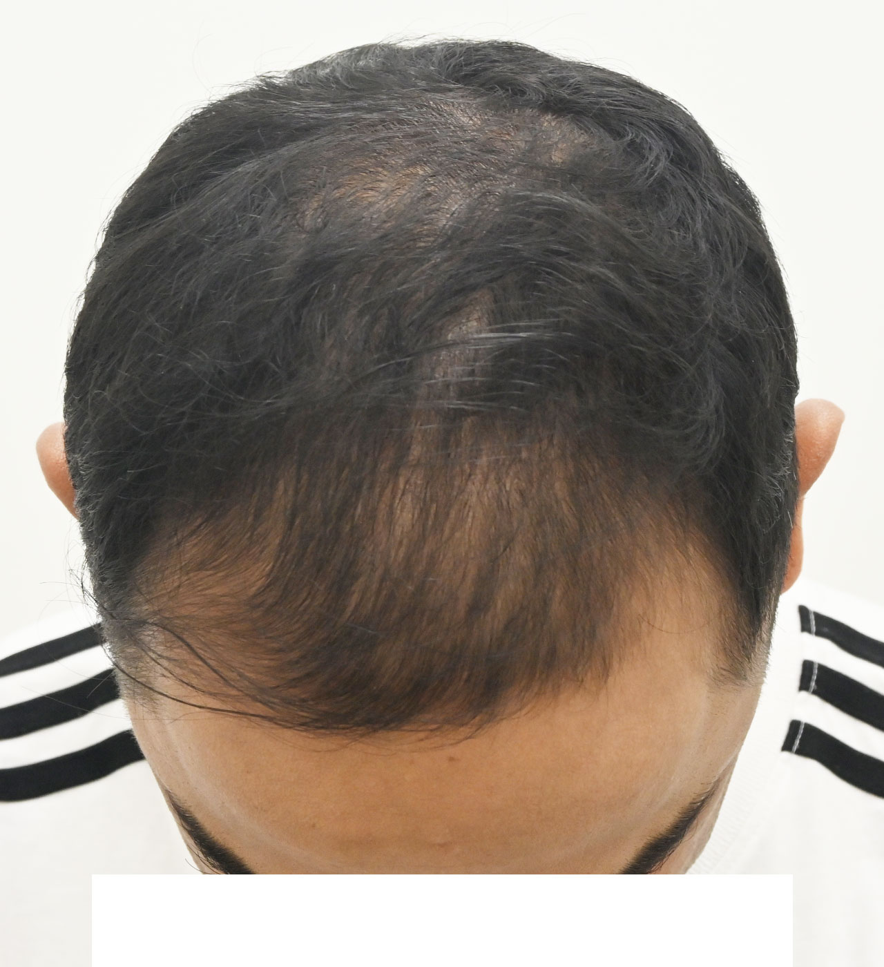 自毛 症例6　after