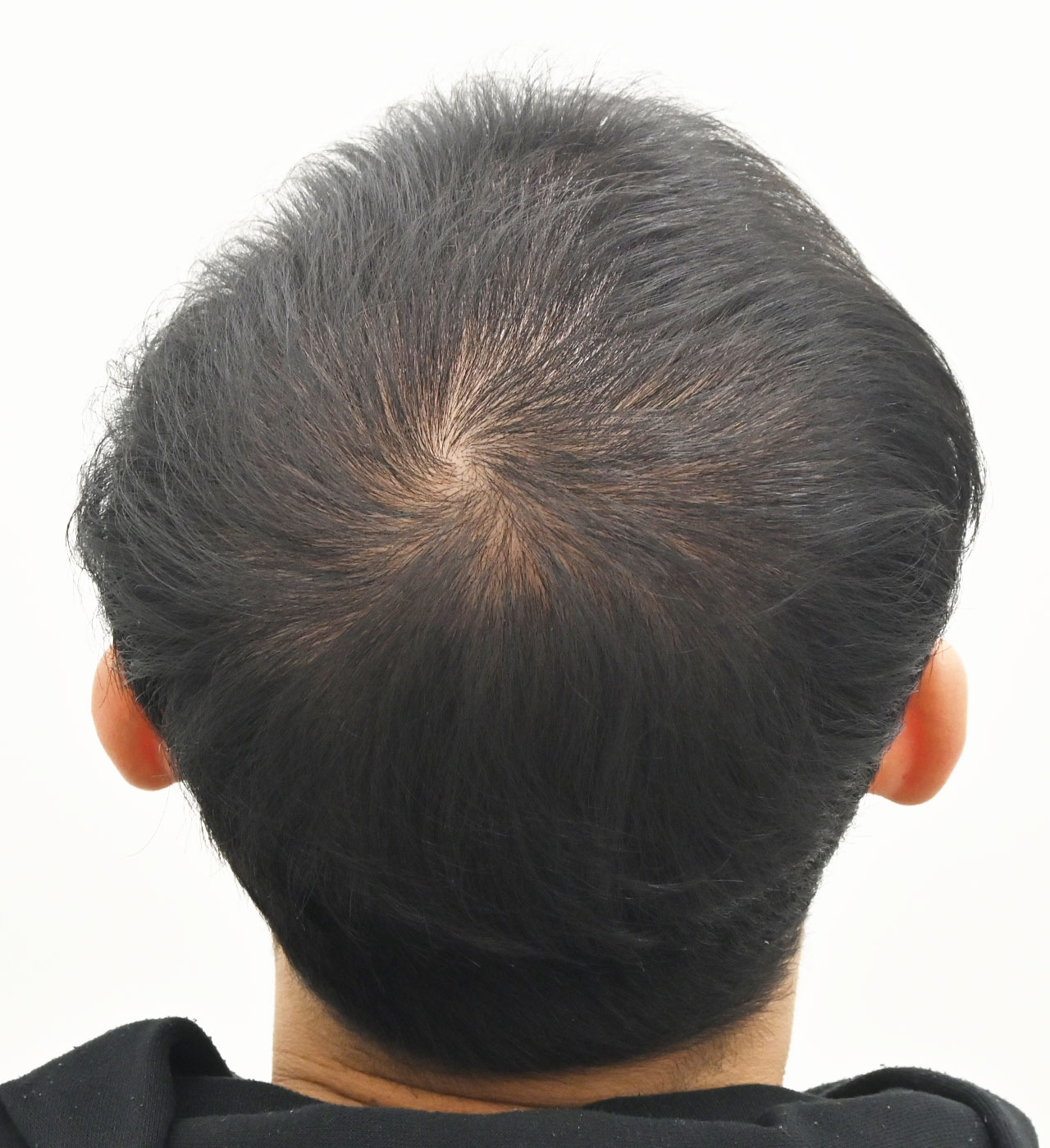 自毛 症例7　after