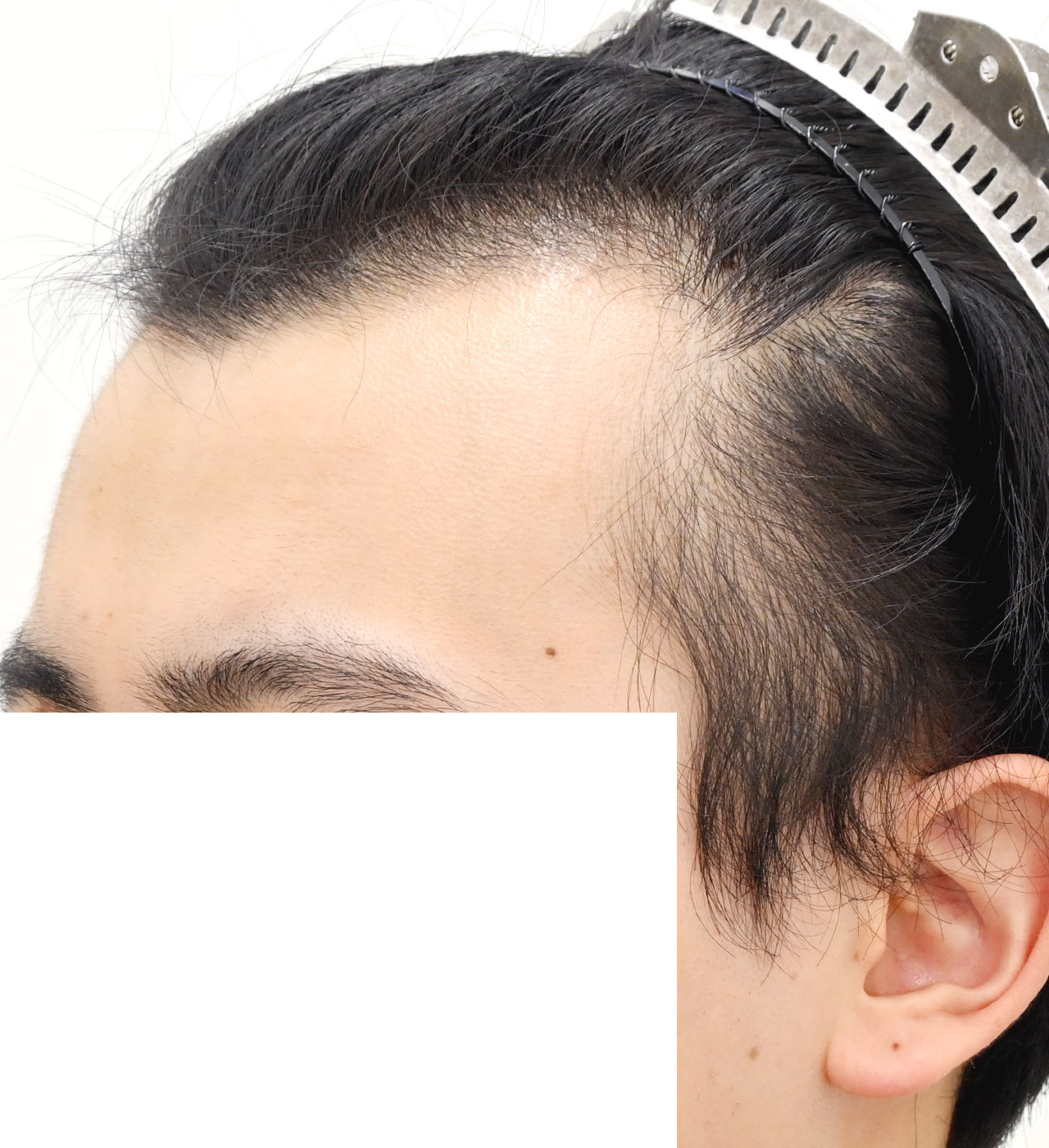 自毛 症例6