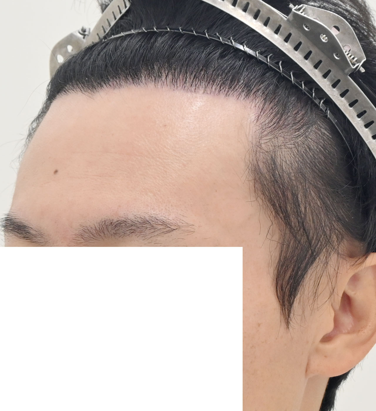 自毛 症例5　after