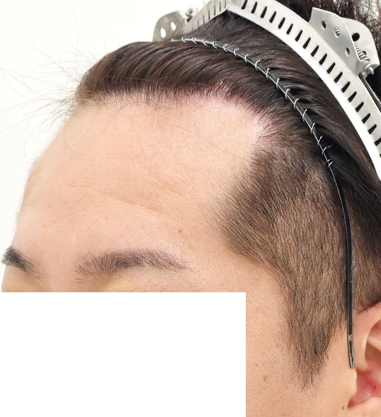 自毛 症例3　after