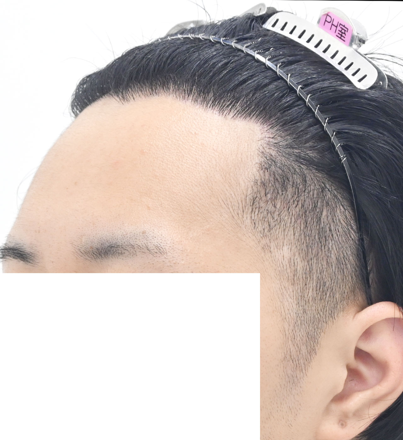 自毛 症例2　after