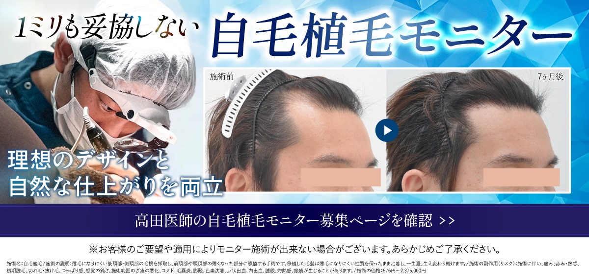 自毛植毛モニター募集中 モニター予約はこちら
