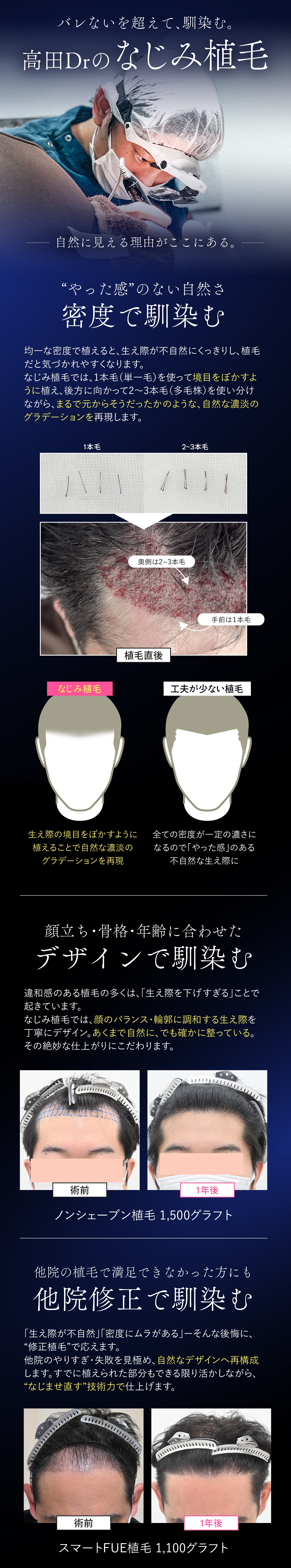 なじみ植毛