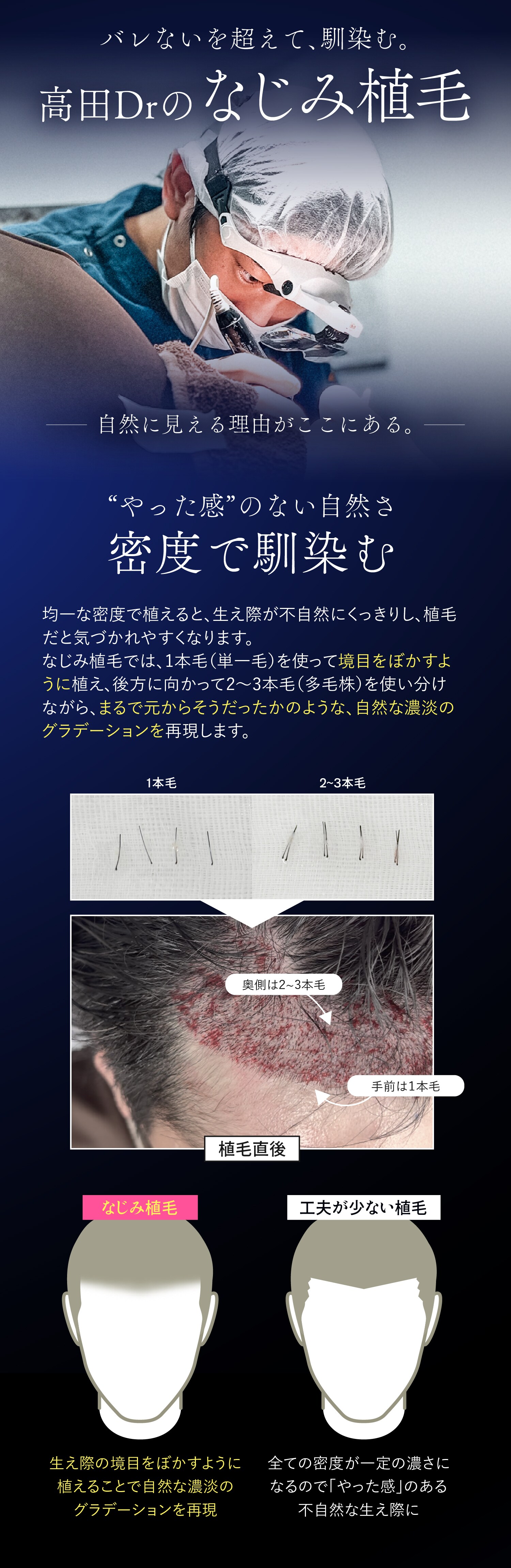 なじみ植毛01