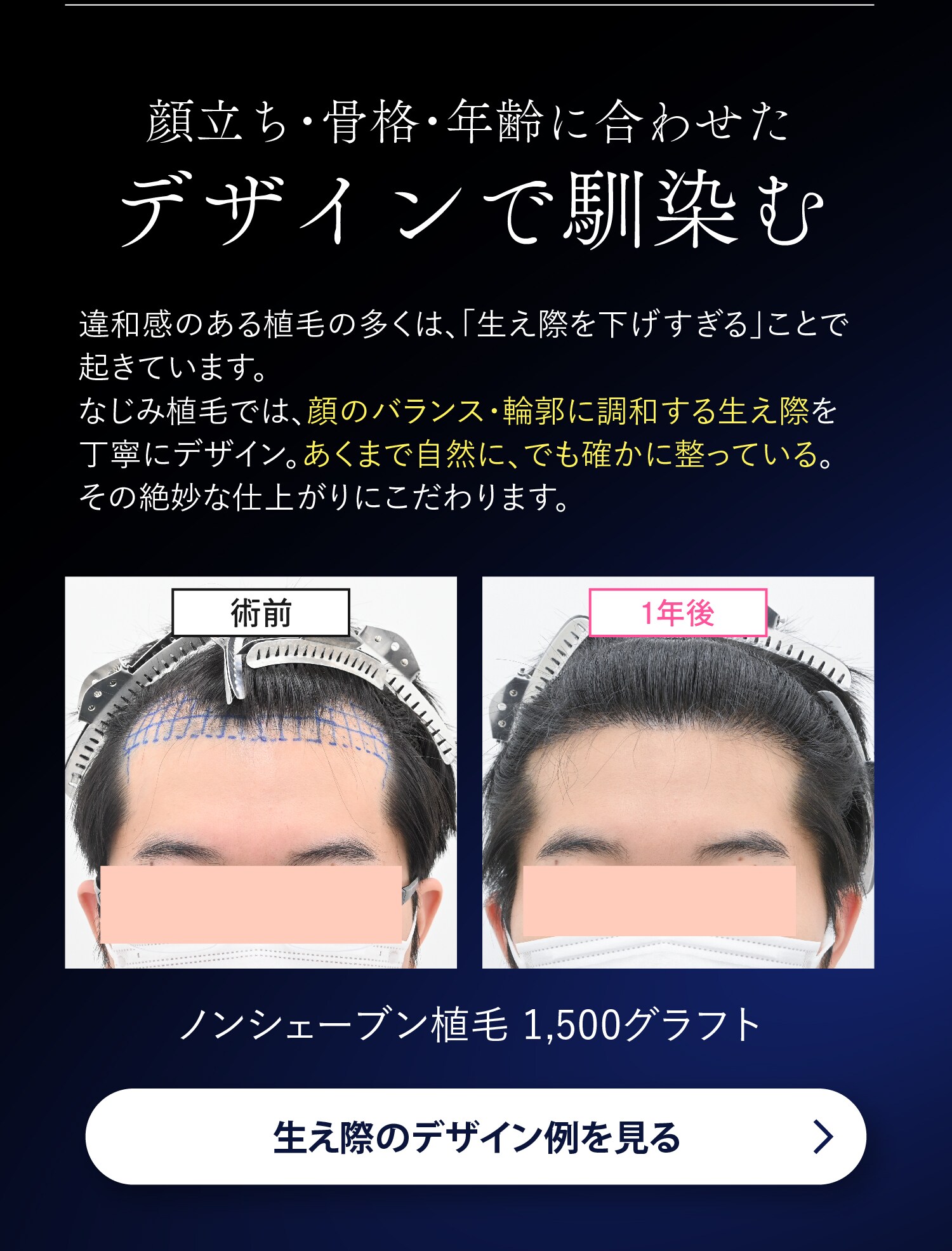 なじみ植毛02