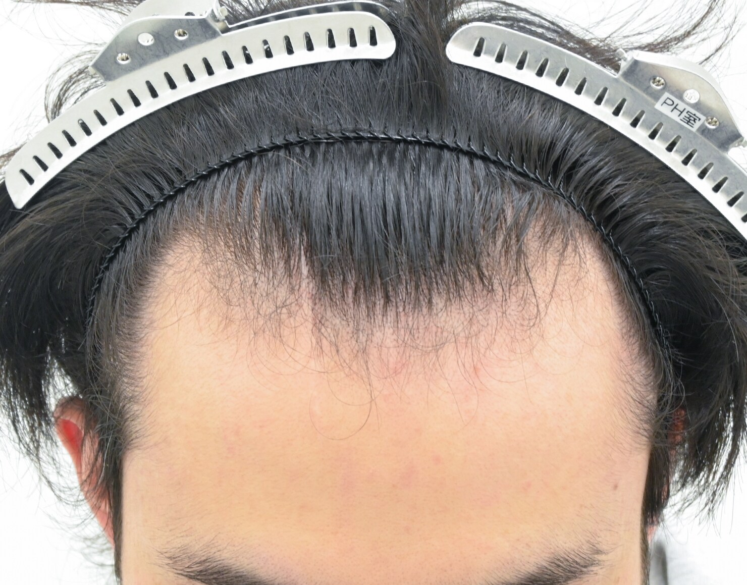 自毛 症例1