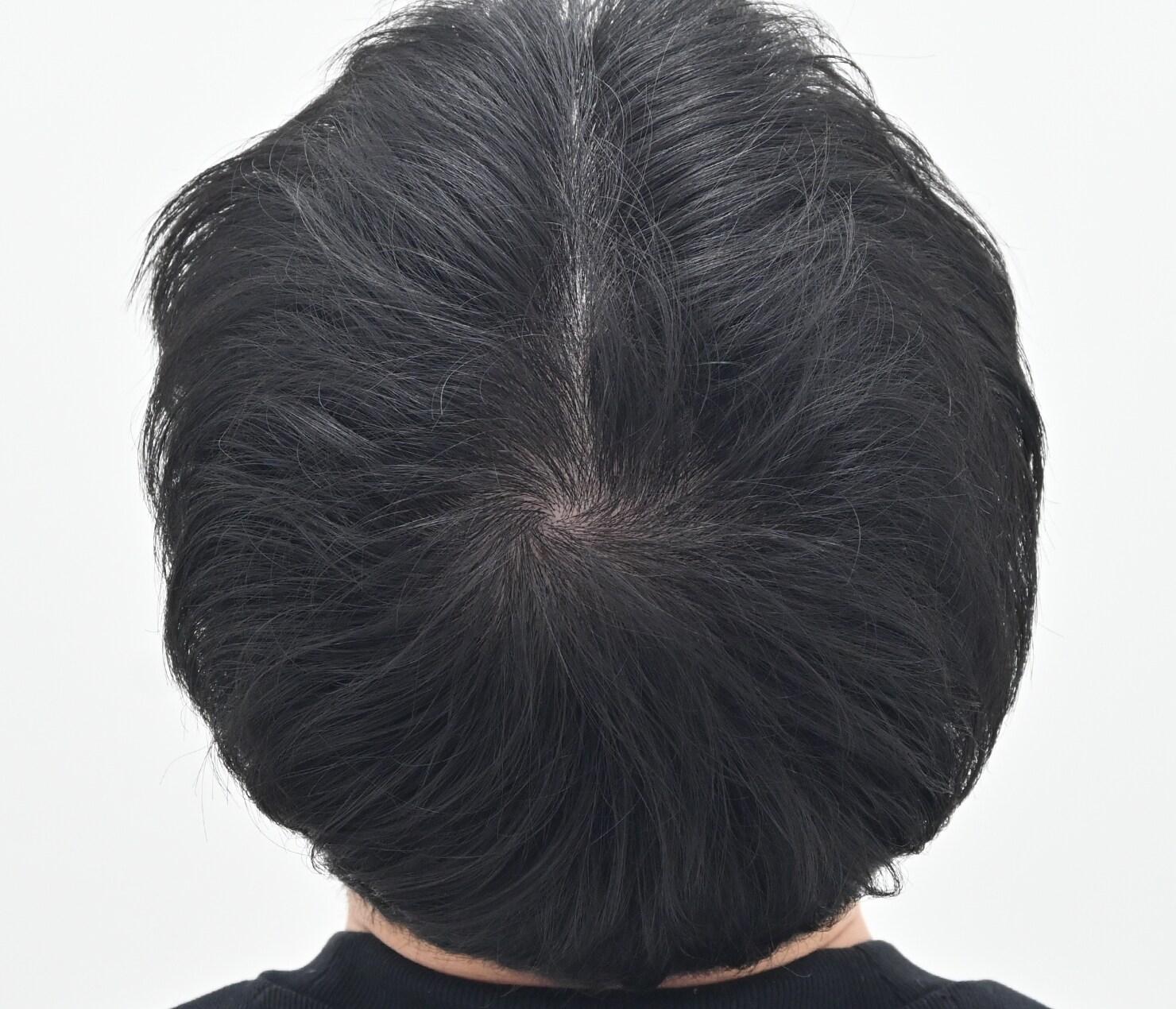 自毛 症例1　after