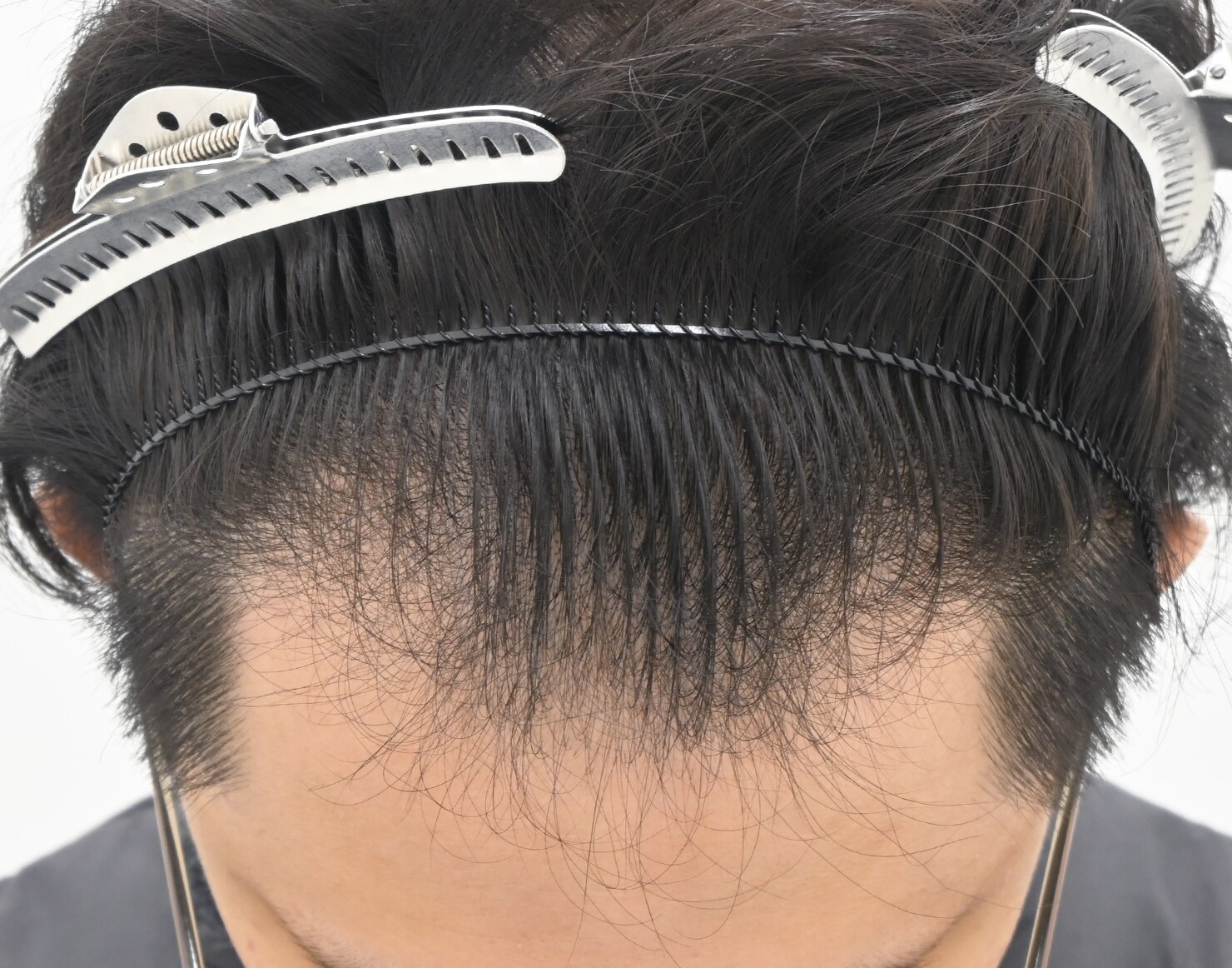 自毛 症例1