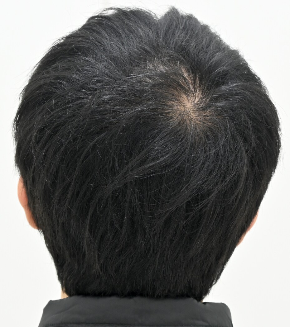 自毛 症例10 after
