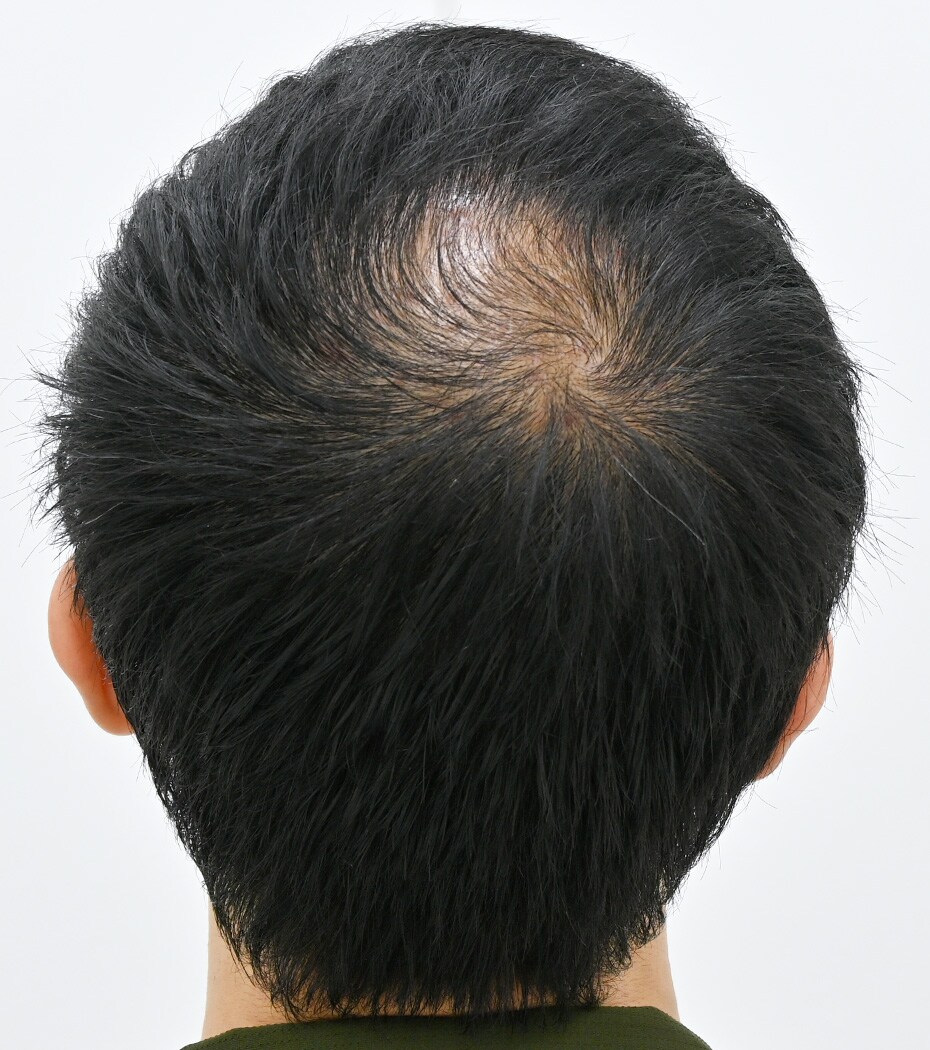 自毛 症例10 before