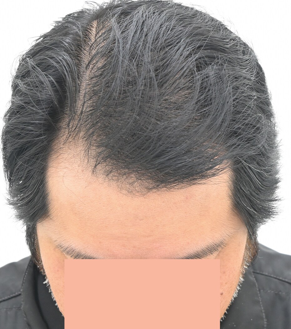 自毛 症例1　after