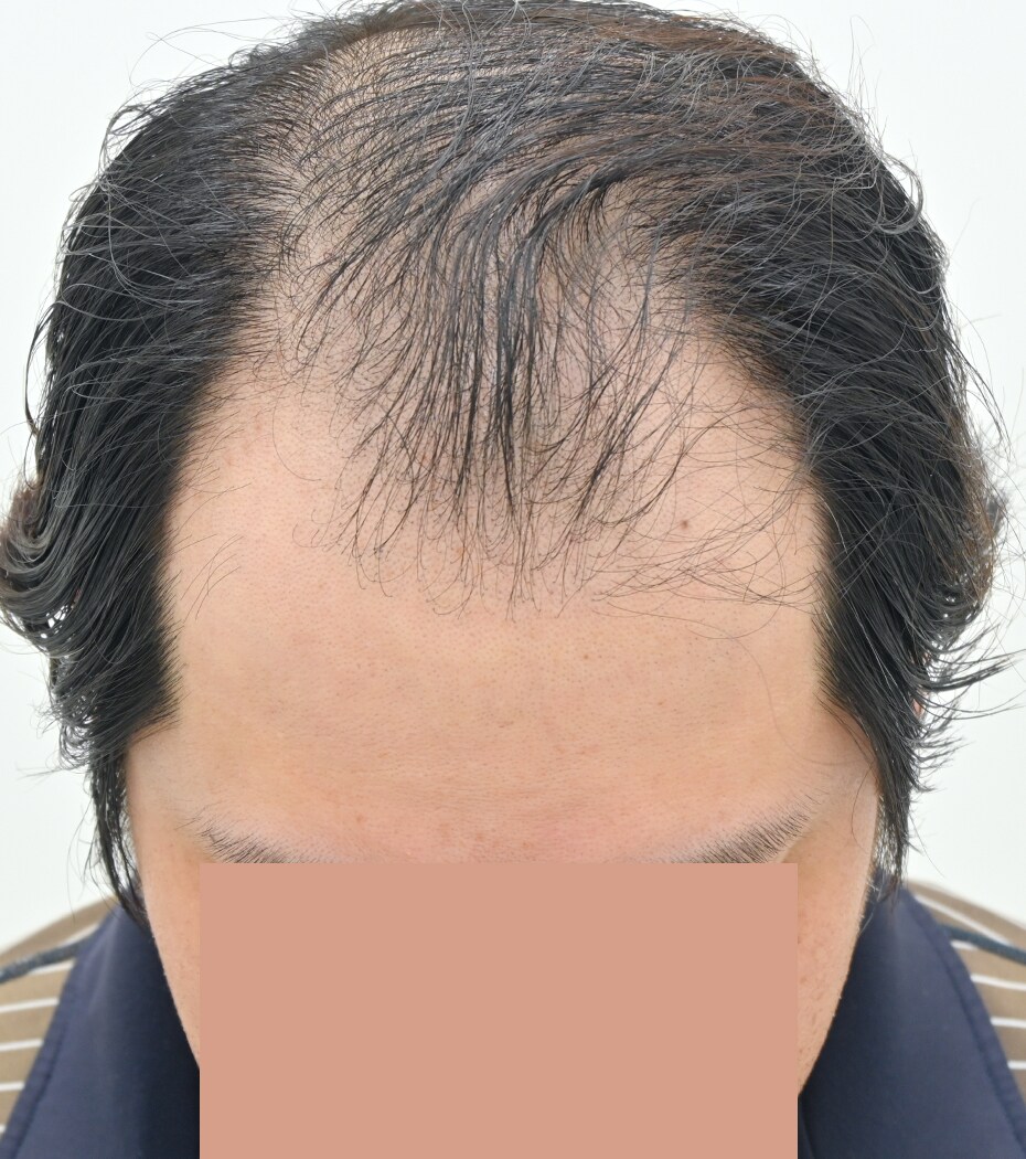 自毛 症例1
