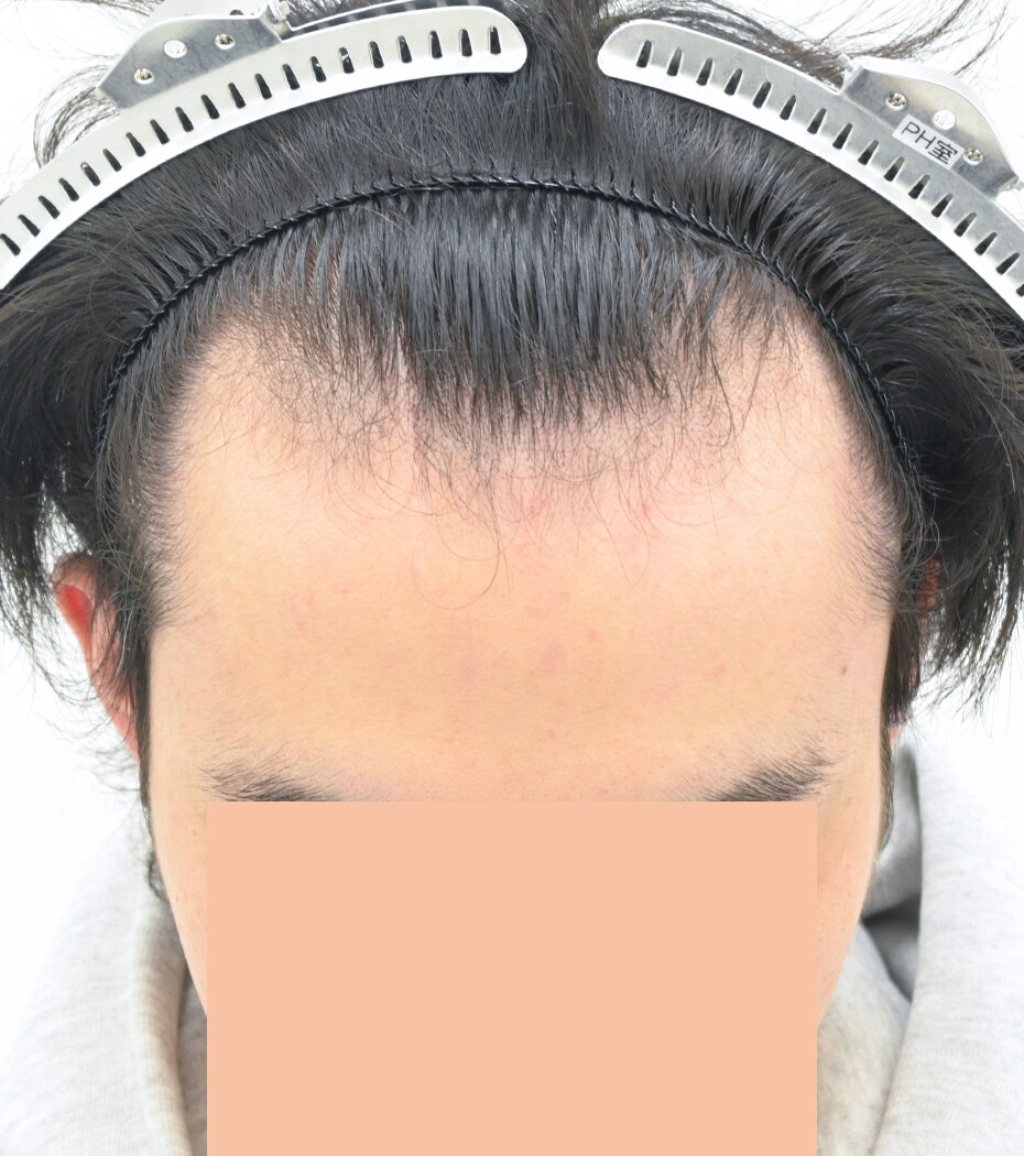 自毛 症例3