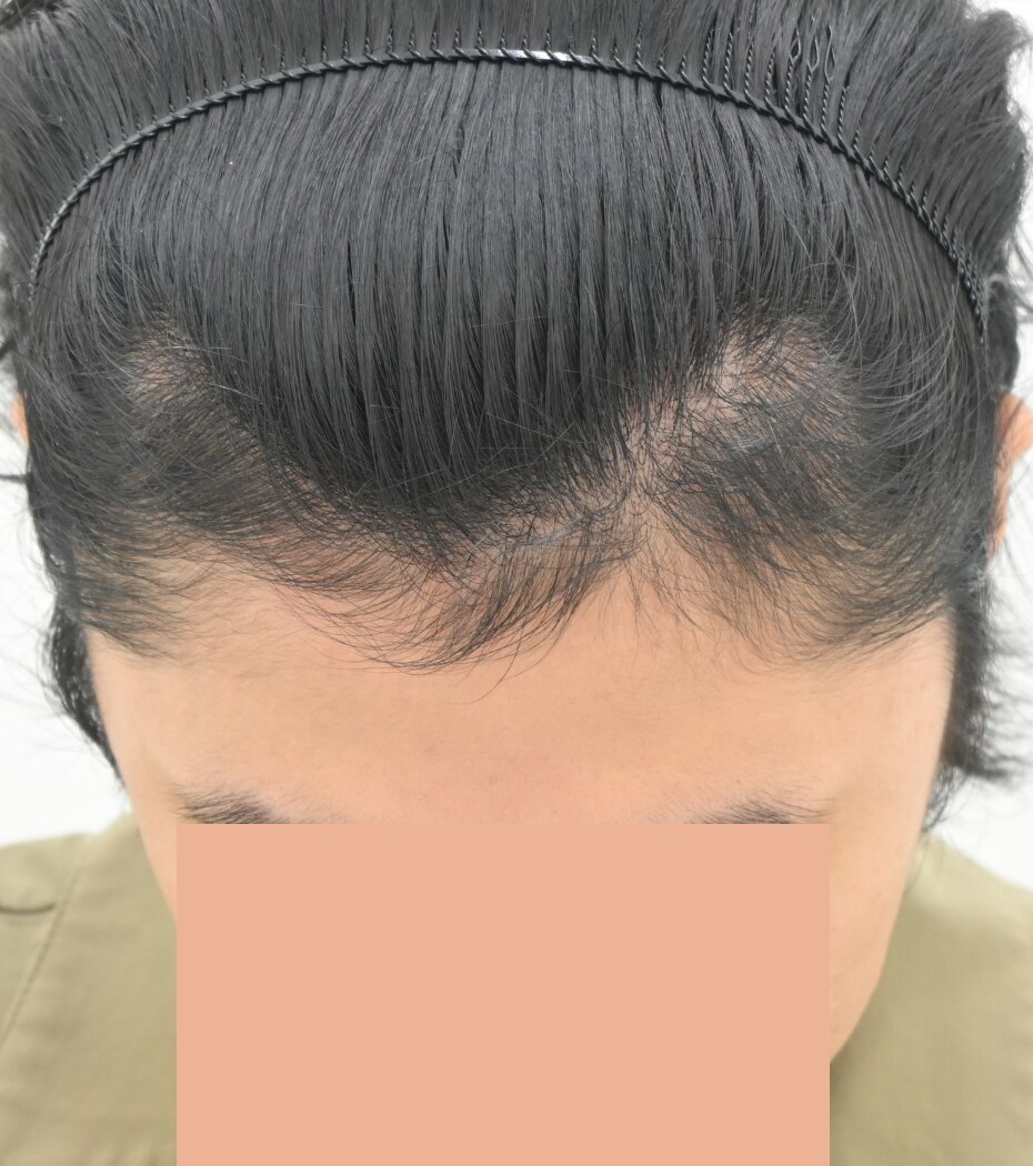 自毛 症例5　after